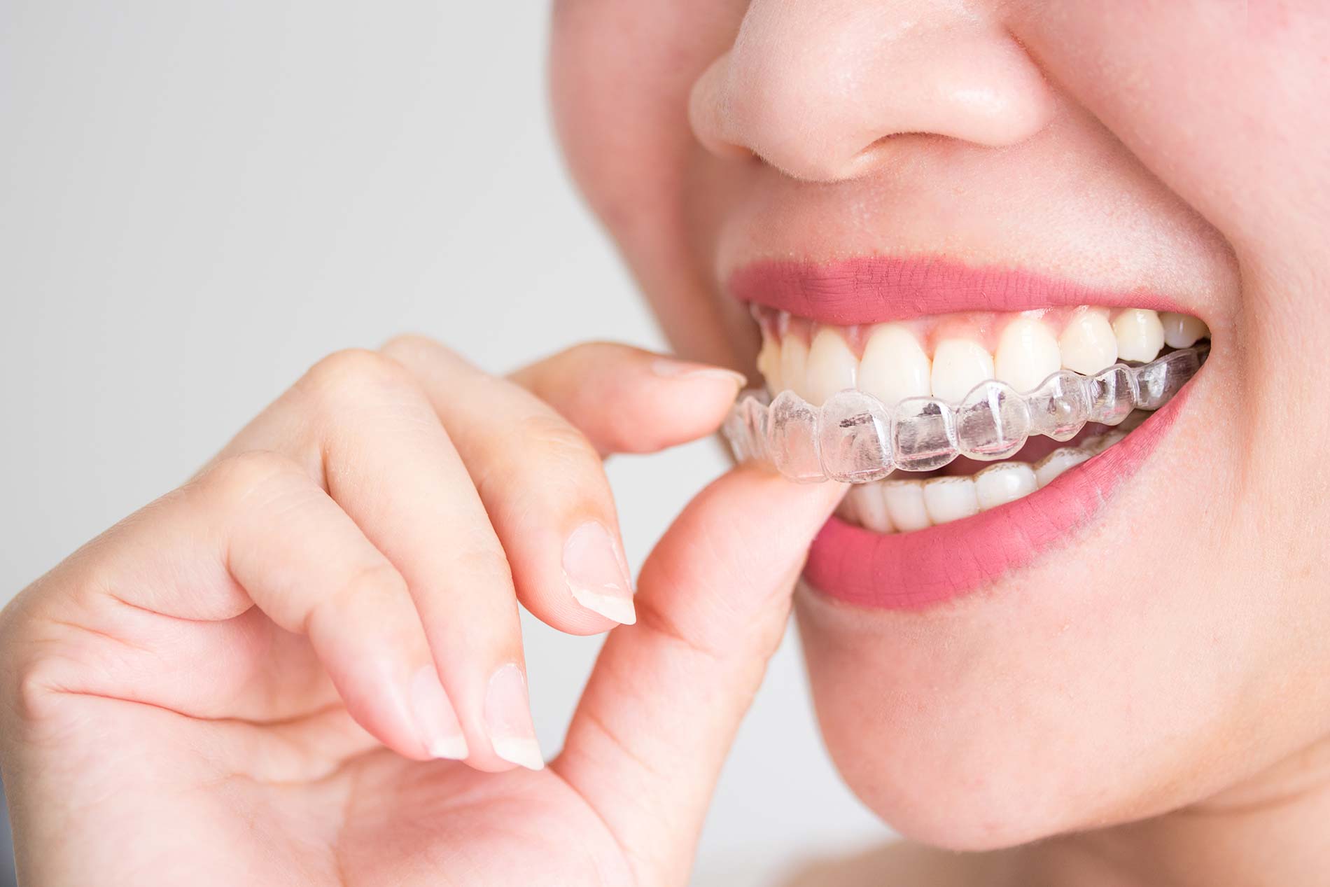 Zeebrasem B olie Zuigeling Orthodontie voor Volwassenen - Wering Orthodontisten